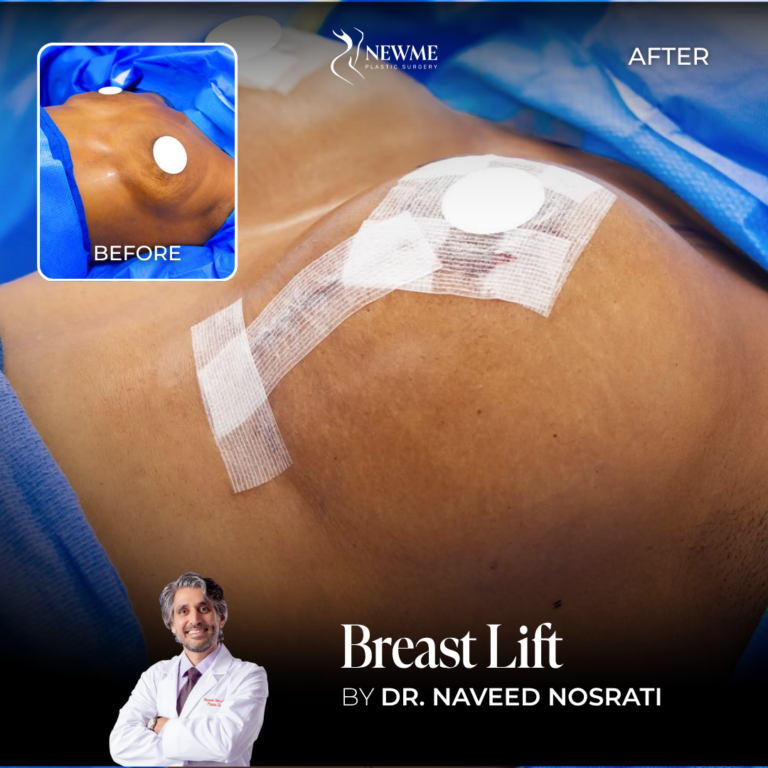 Dr. Nosrati Breast Lift