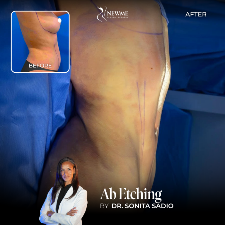 Dr. Sadio Abdominal Etching