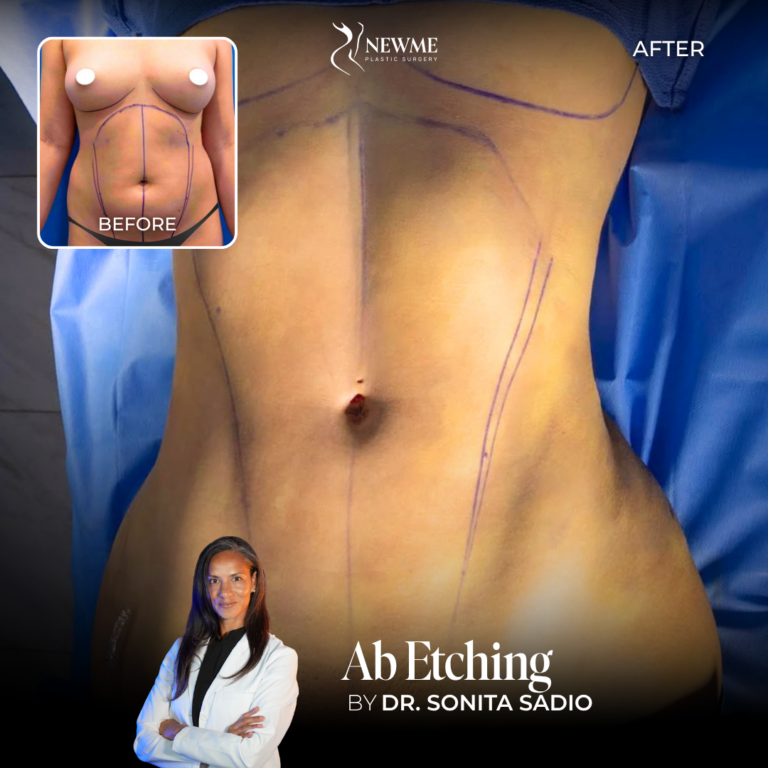 Dr. Sadio Abdominal Etching