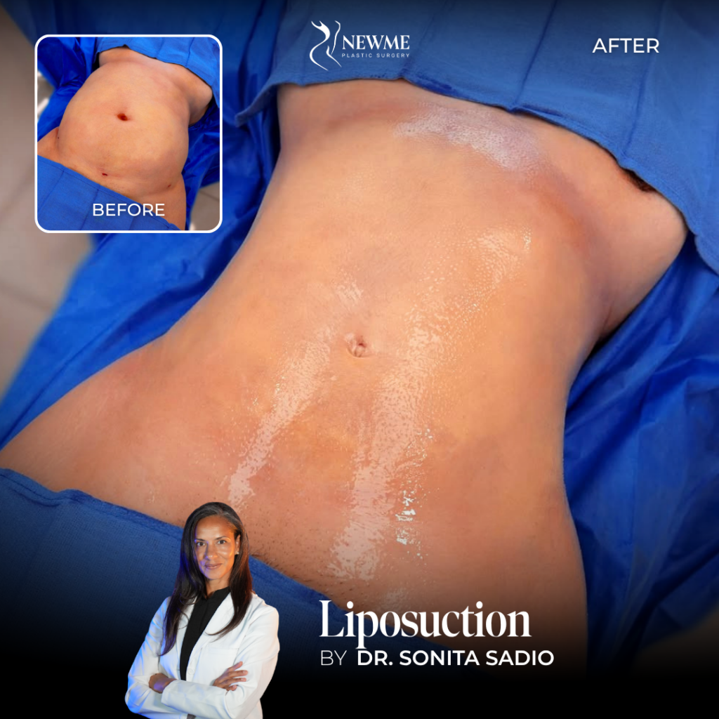 Dr. Sadio Liposuction