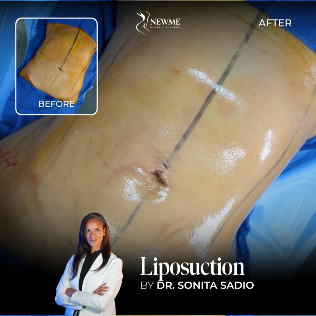 Liposuction Before and After by Dr. Sadio