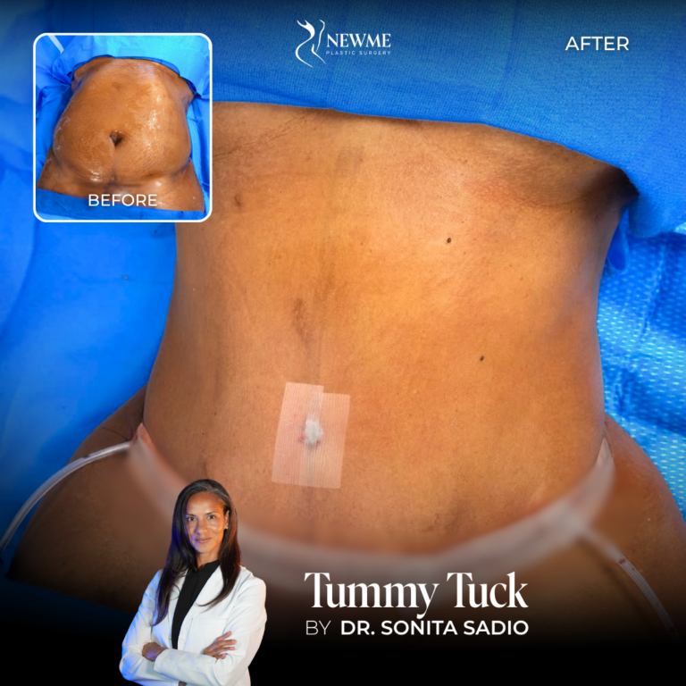 Dr. Sadio Tummy Tuck