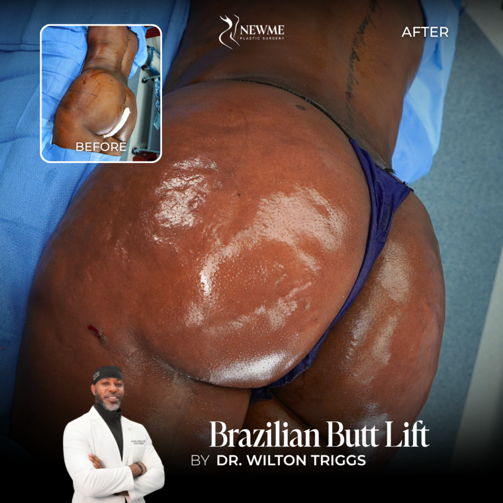 Brazilian Butt Lift Before and After by Dr. Triggs