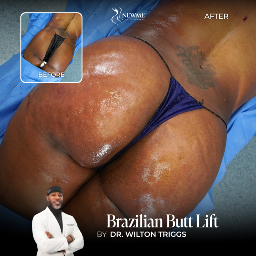 Brazilian Butt Lift Before and After by Dr. Triggs