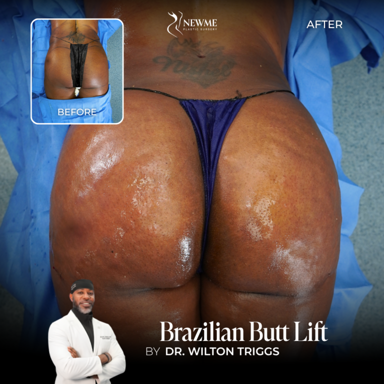 Brazilian Butt Lift Before and After by Dr. Triggs