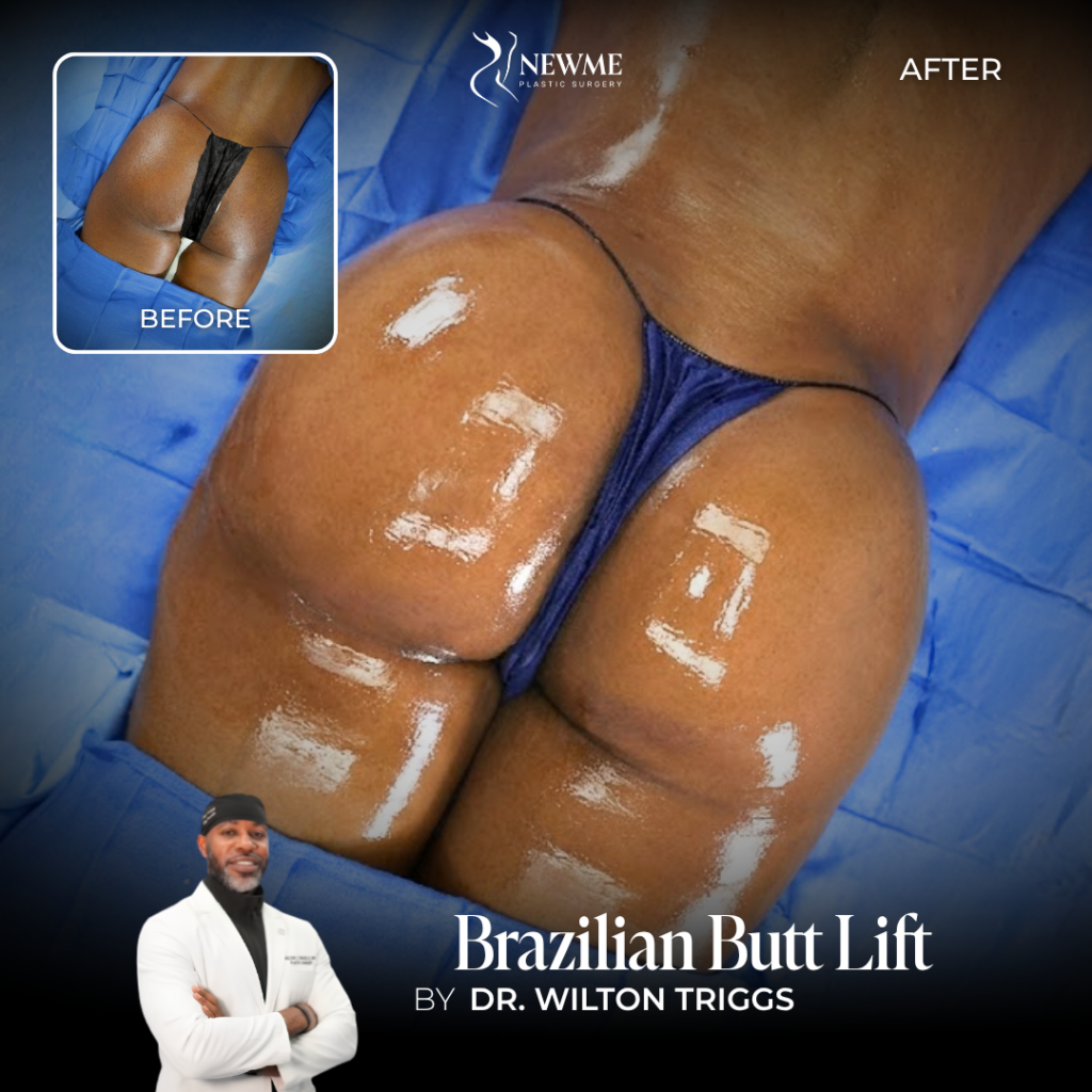Brazilian Butt Lift Before and After by Dr. Triggs