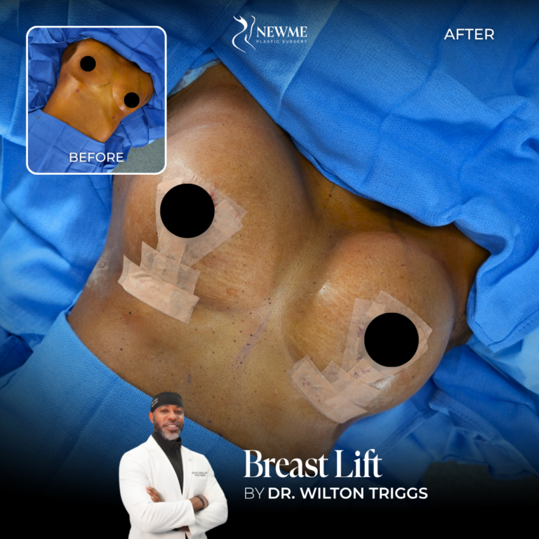 Breast Lift Before and After by Dr. Triggs