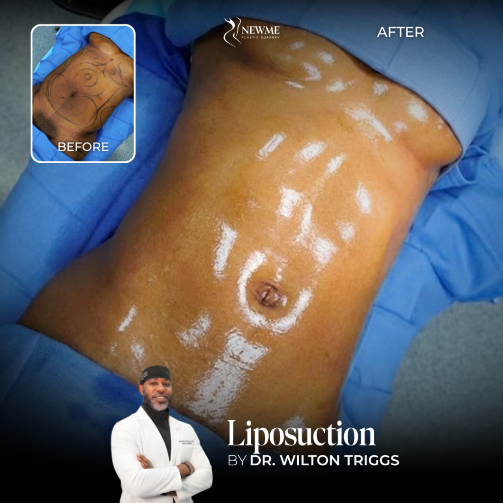 Liposuction Before and After by Dr. Triggs