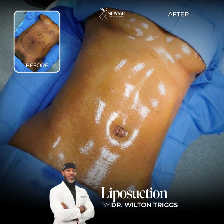 Liposuction Before and After by Dr. Triggs
