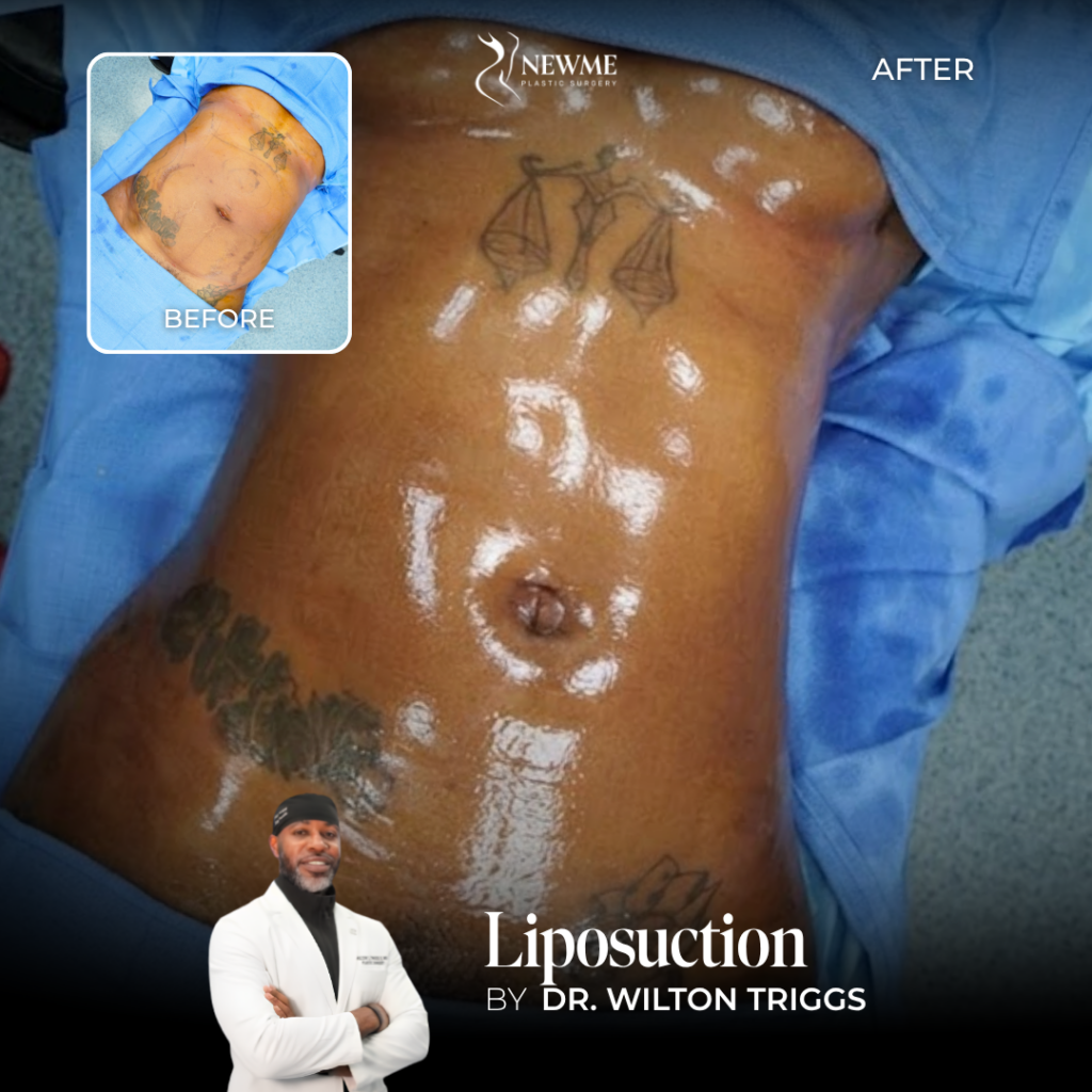 Liposuction Before and After by Dr. Triggs