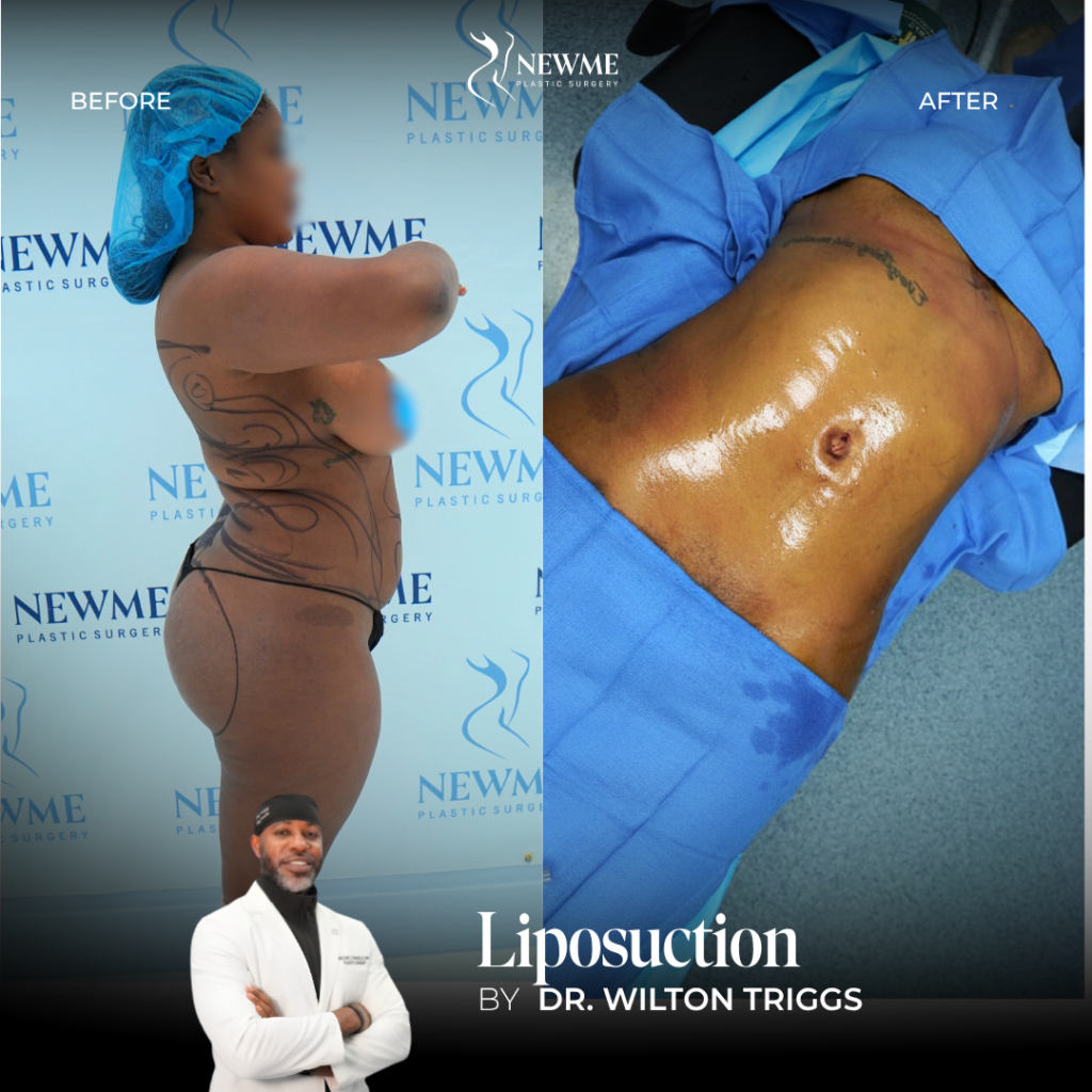 Liposuction Before and After by Dr. Triggs