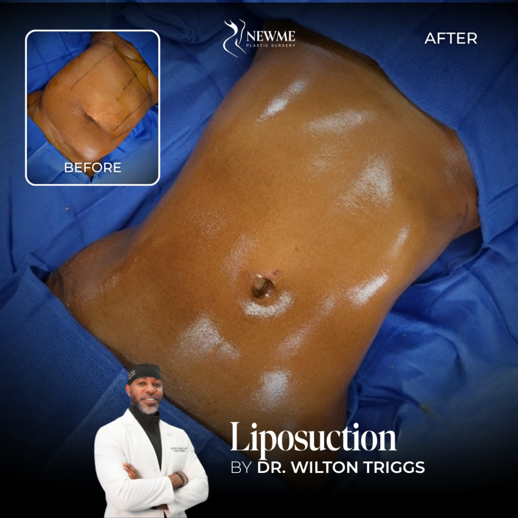 Liposuction Before and After by Dr. Triggs