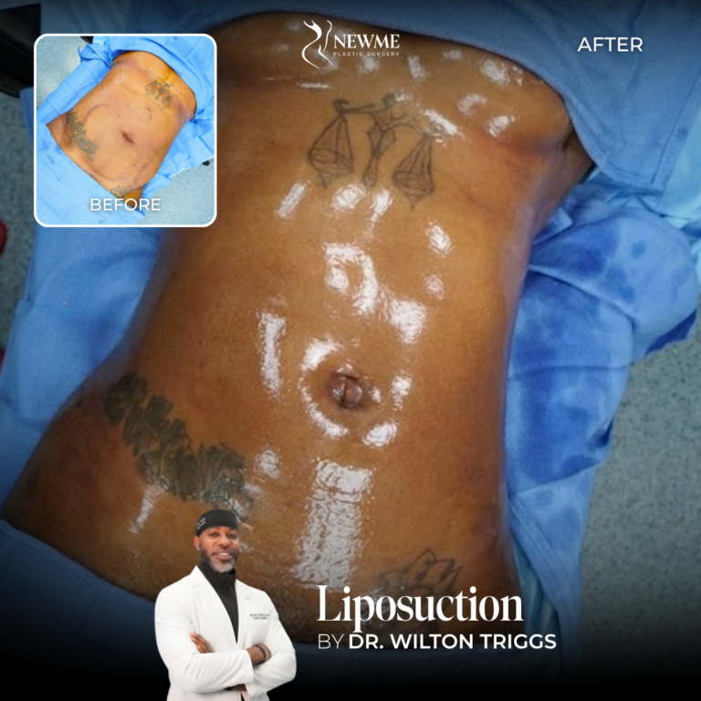 Liposuction Before and After by Dr. Triggs