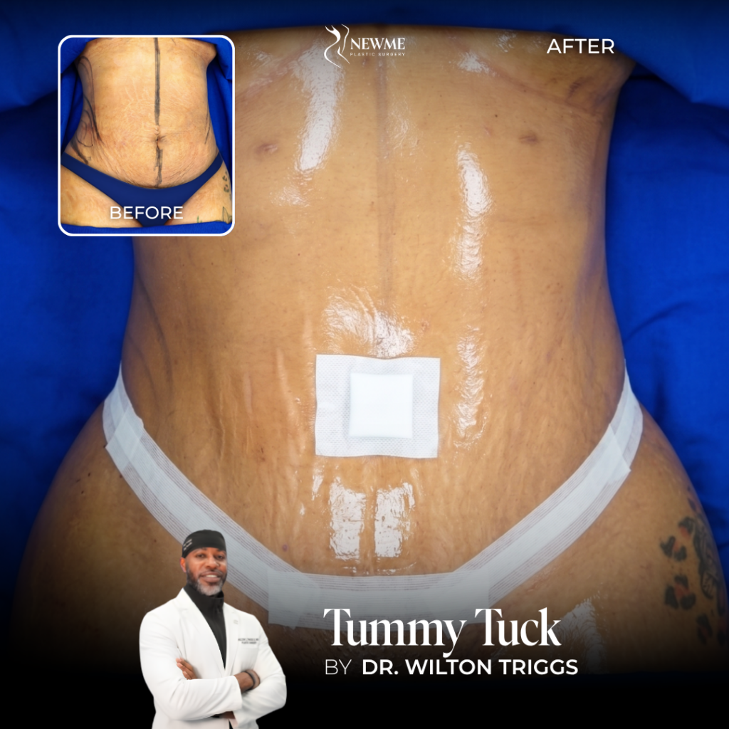 Tummy Tuck Before and After by Dr. Triggs