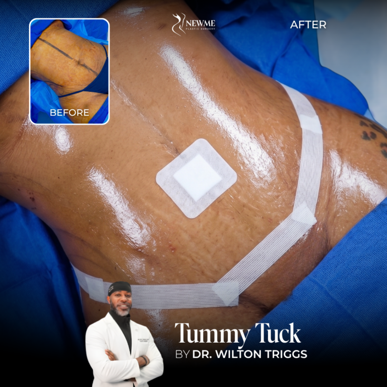 Tummy Tuck Before and After by Dr. Triggs