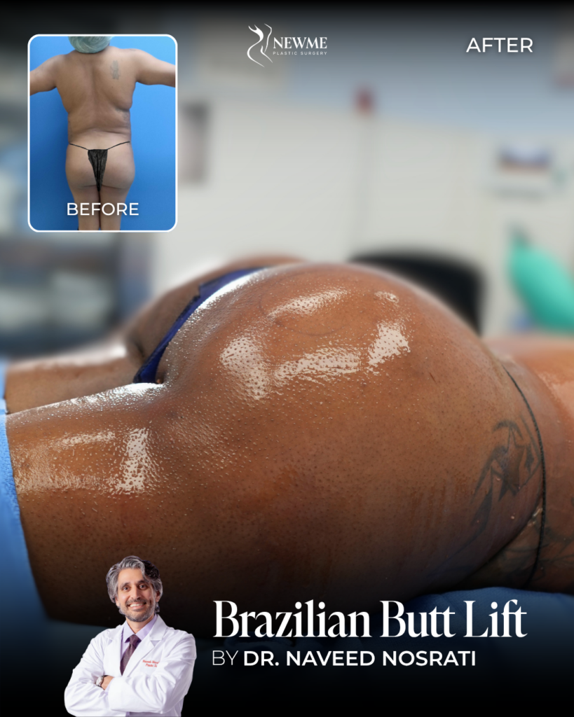Dr. Nosrati BBL