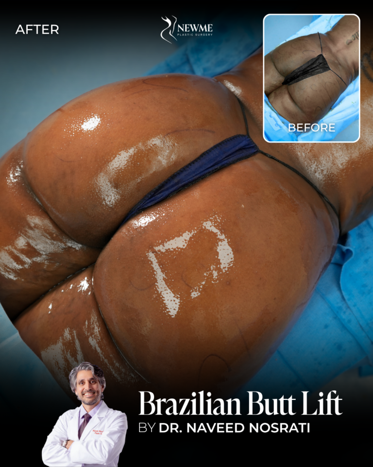 Dr. Nosrati BBL