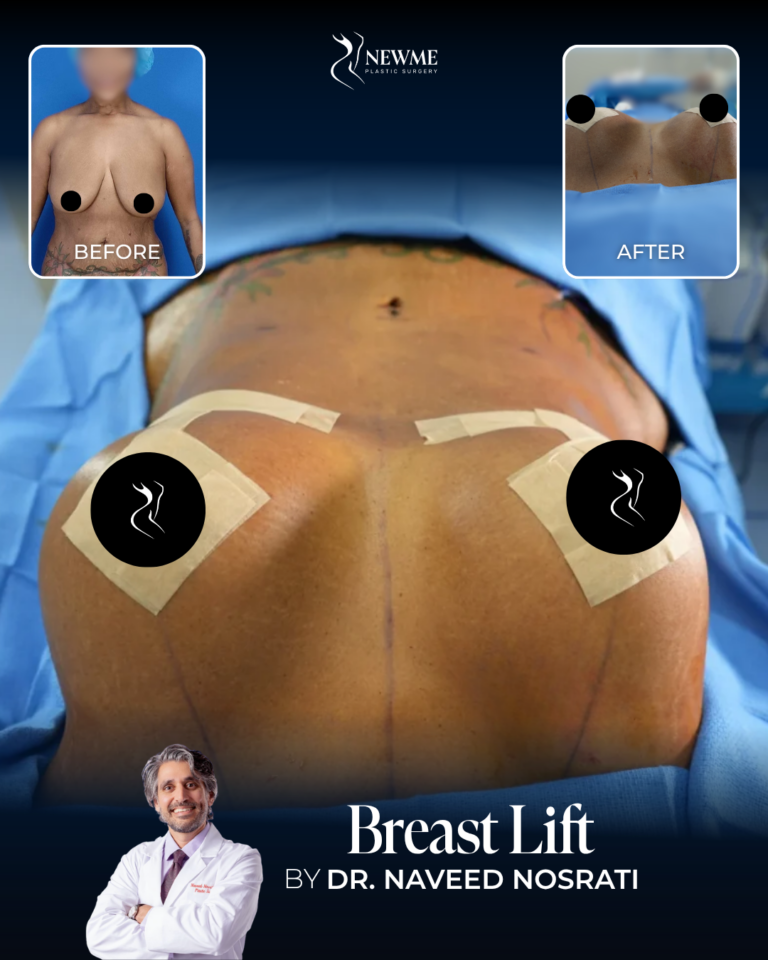 Breast Lift — Dr. Nosrati
