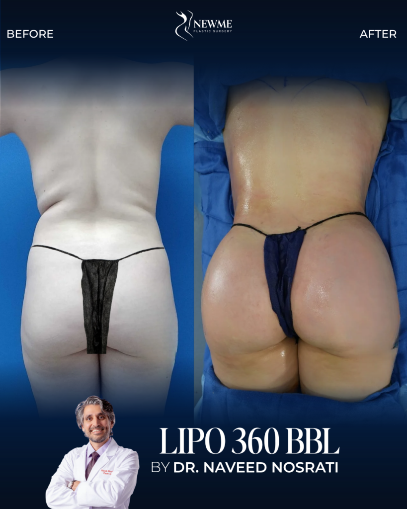 BBL — Dr. Nosrati