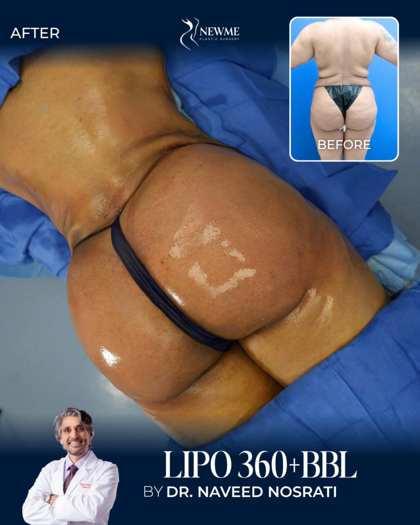 BBL — Dr. Nosrati