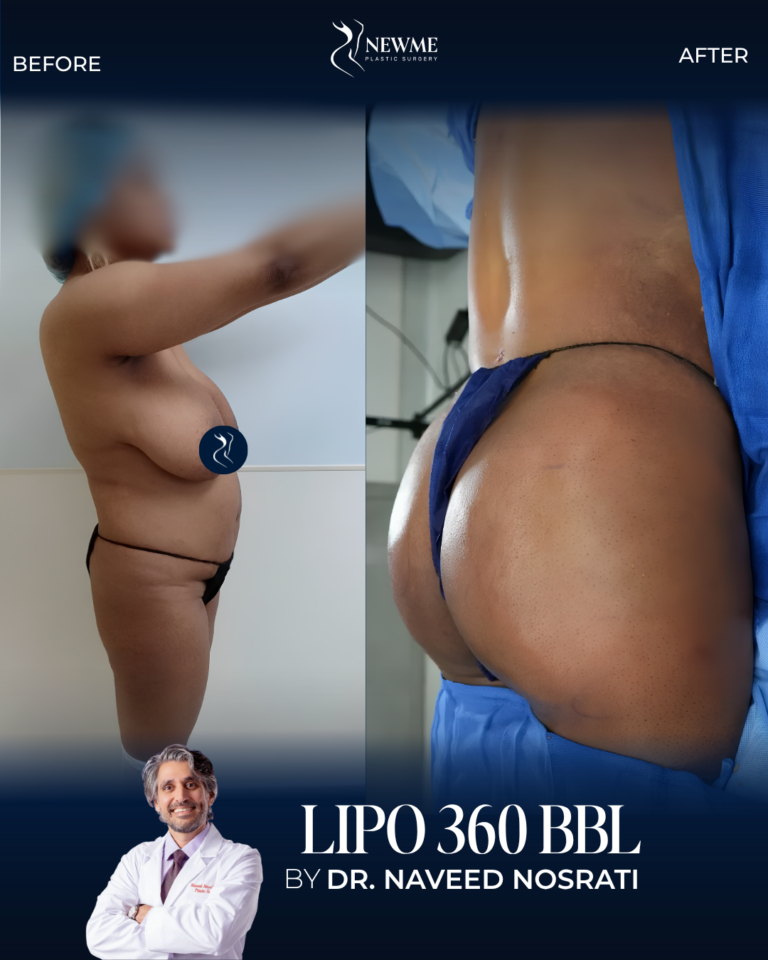 BBL — Dr. Nosrati