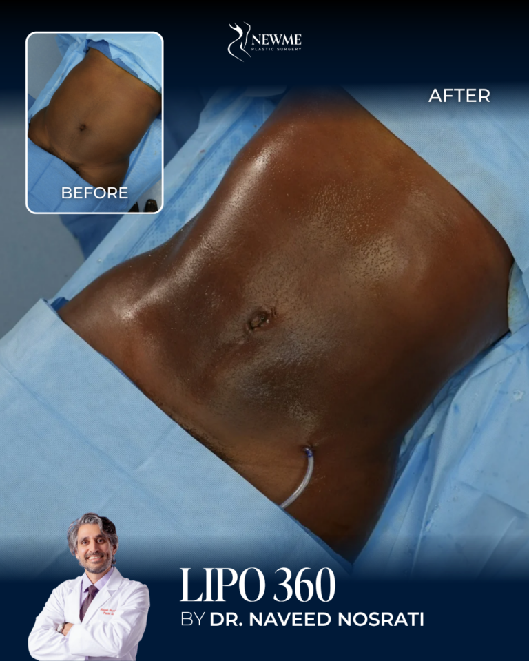 Liposuction — Dr. Nosrati