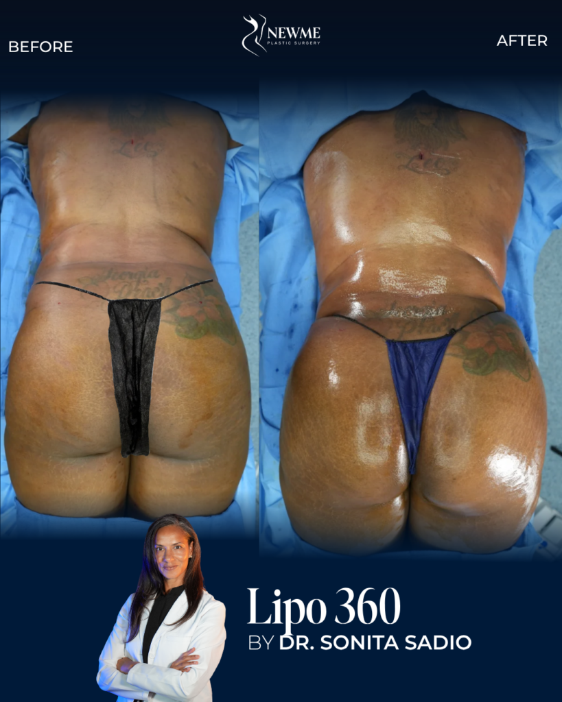 Liposuction — Dr. Sadio