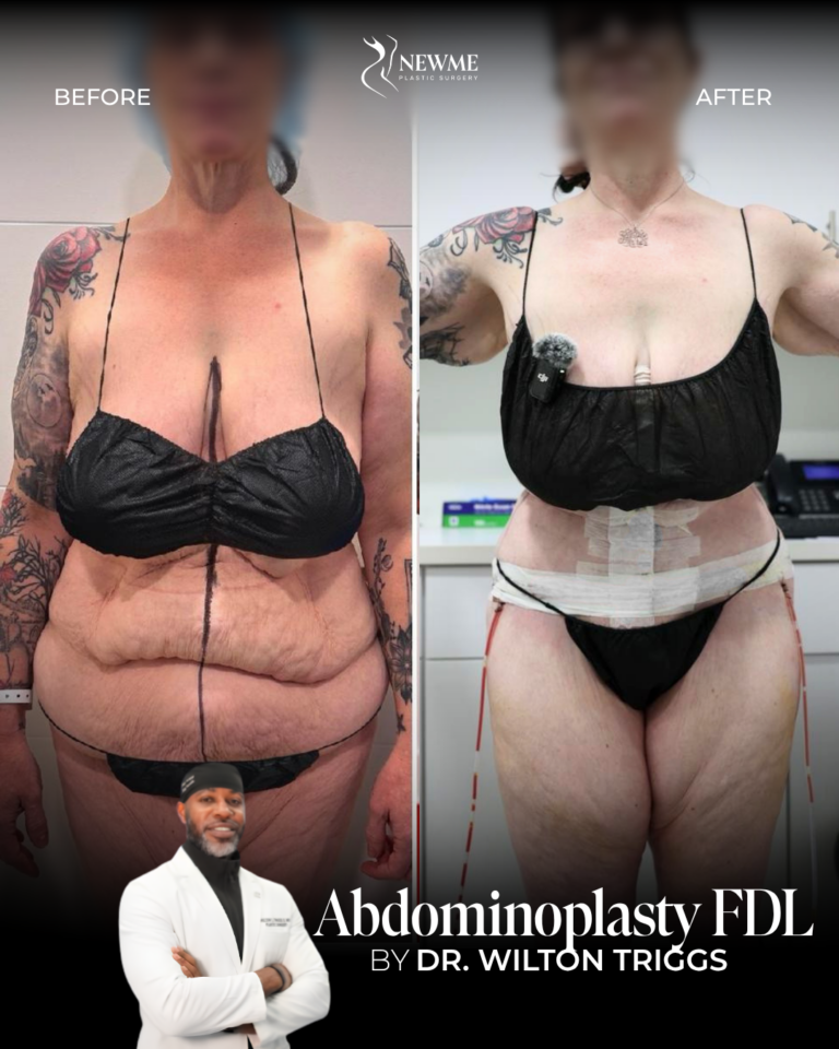 Tummy Tuck — Dr. Triggs