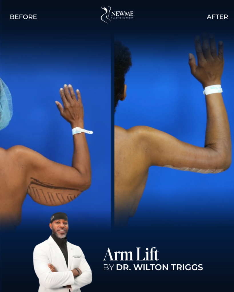 Arm Lift — Dr. Triggs