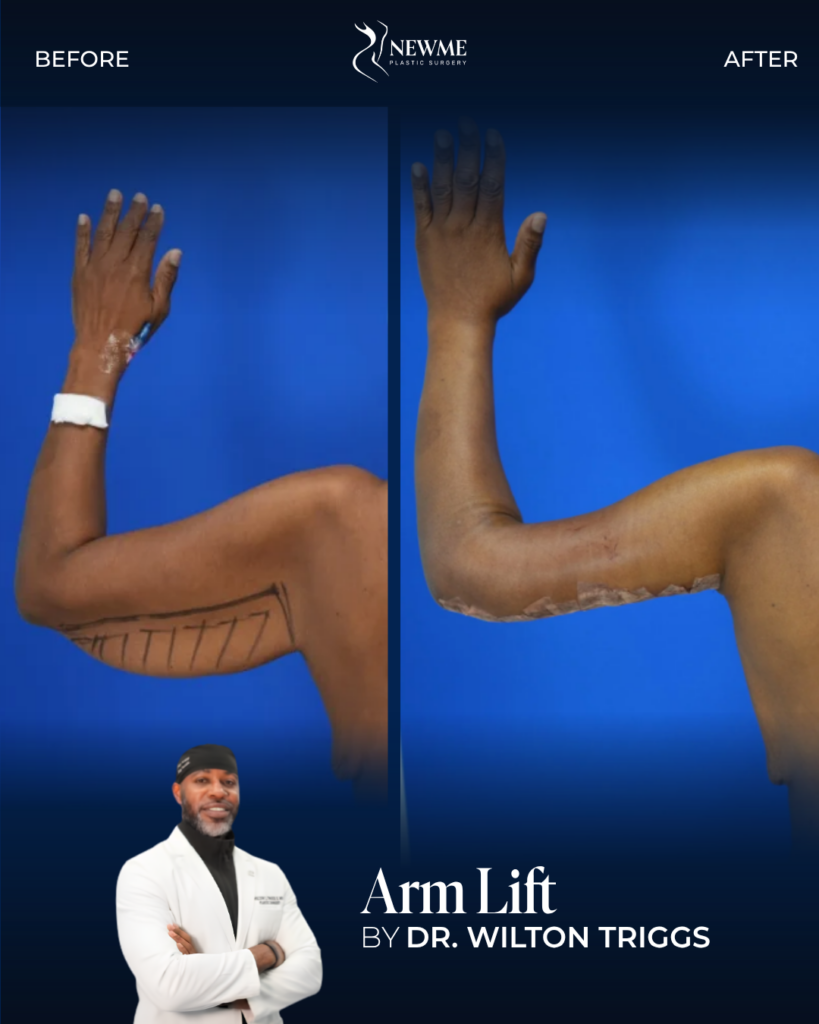 Arm Lift — Dr. Triggs
