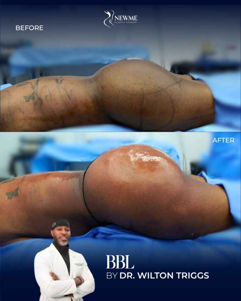 BBL — Dr. Triggs