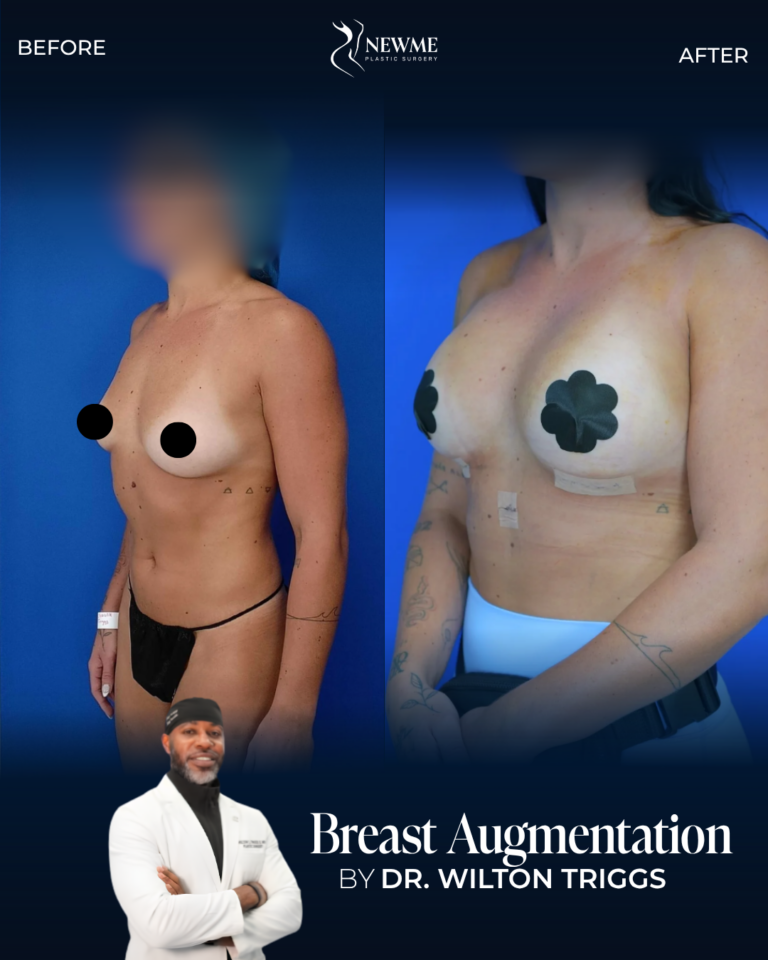 Breast Augmentation — Dr. Triggs