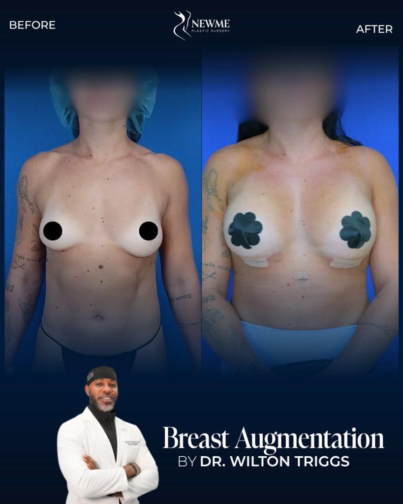 Breast Augmentation — Dr. Triggs