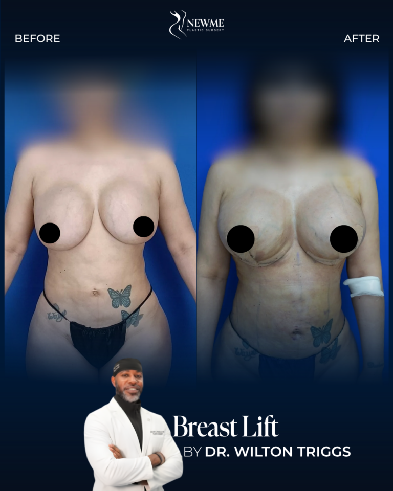 Breast Lift — Dr. Triggs