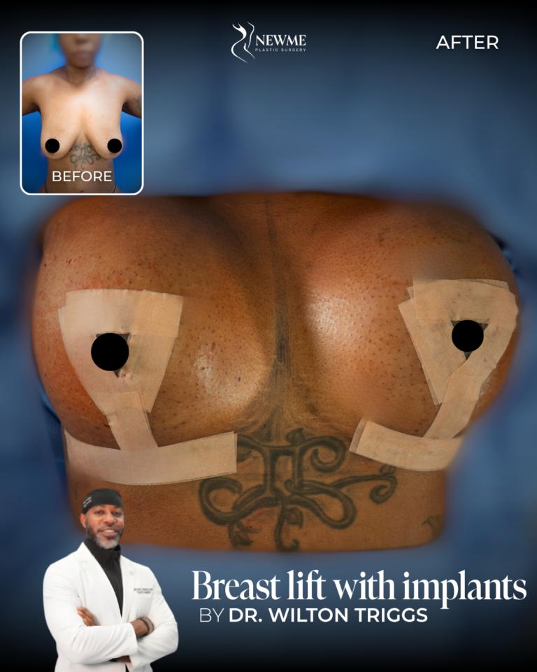 Breast Lift — Dr. Triggs