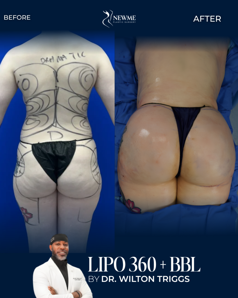 BBL — Dr. Triggs