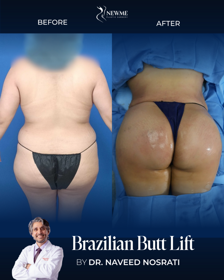 Brazilian Butt Lift result by Dr. Naveed Nosrati at New Me Plastic Surgery, Miami