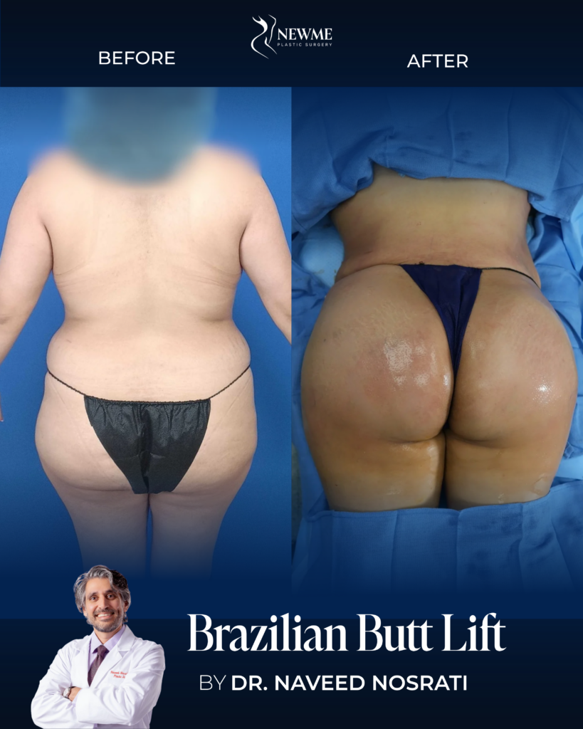 Brazilian Butt Lift result by Dr. Naveed Nosrati at New Me Plastic Surgery, Miami