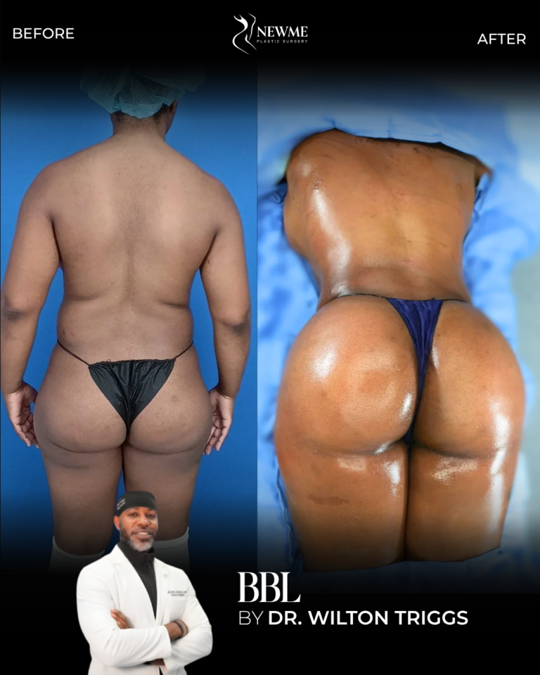 Brazilian Butt Lift result by Dr. Wilton Triggs at New Me Plastic Surgery, Miami