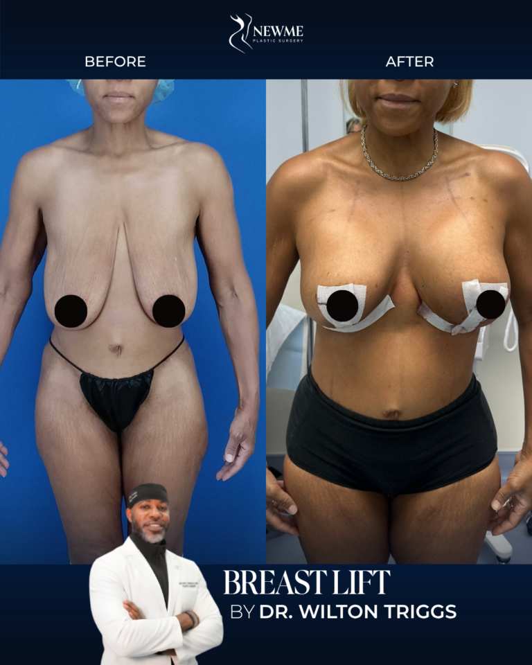 Breast Lift result by Dr. Wilton Triggs at New Me Plastic Surgery, Miami