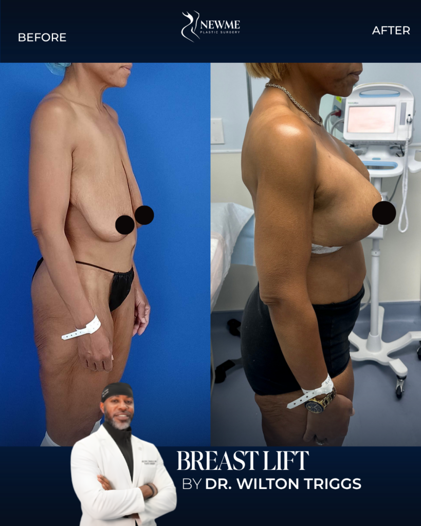 Breast Lift result by Dr. Wilton Triggs at New Me Plastic Surgery, Miami