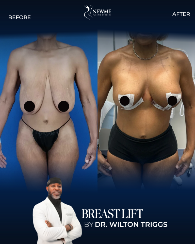 Breast Lift result by Dr. Wilton Triggs at New Me Plastic Surgery, Miami