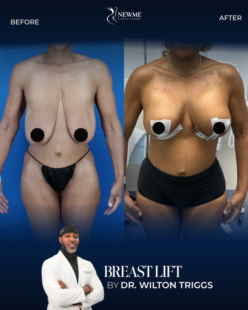 Breast Lift result by Dr. Wilton Triggs at New Me Plastic Surgery, Miami