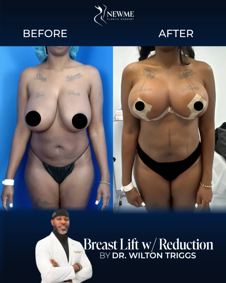 Breast Lift with Reduction result by Dr. Wilton Triggs at New Me Plastic Surgery, Miami