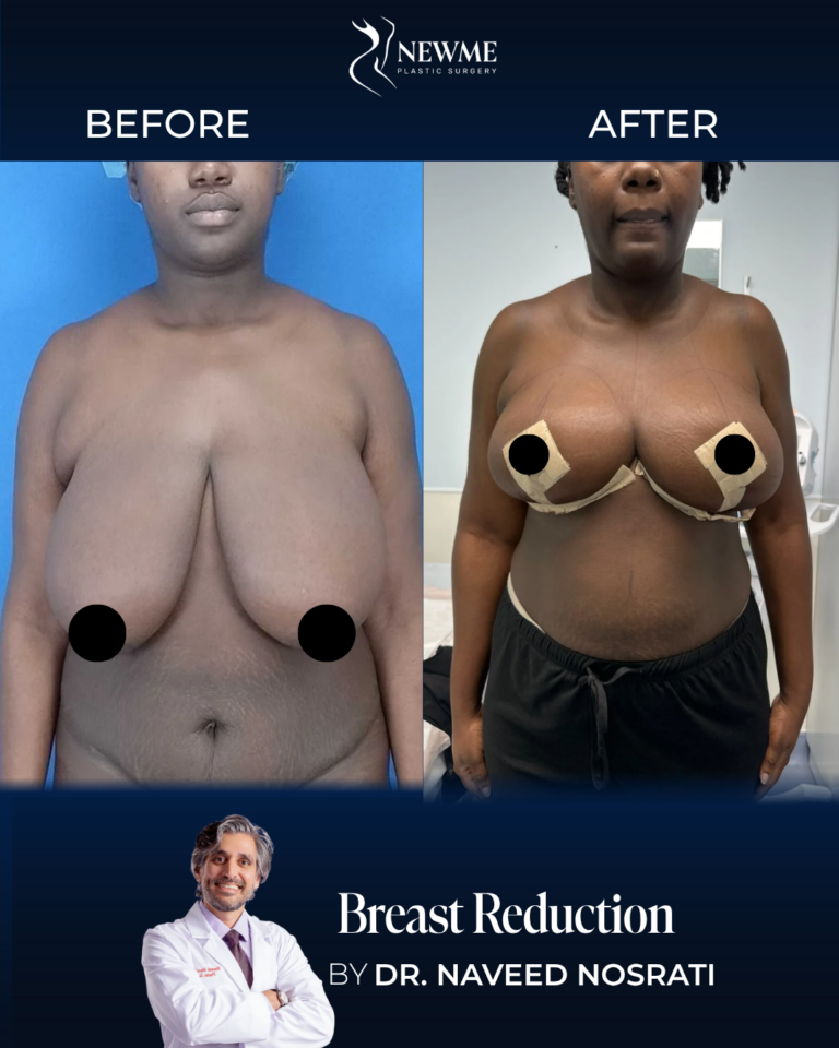 Breast Reduction result by Dr. Naveed Nosrati at New Me Plastic Surgery, Miami
