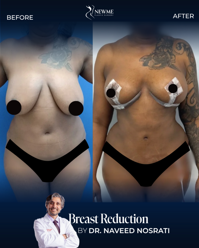 Breast Reduction result by Dr. Naveed Nosrati at New Me Plastic Surgery, Miami
