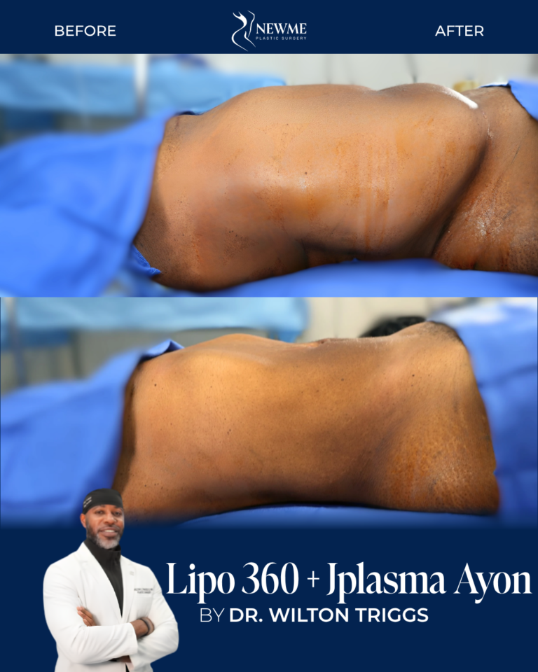J-Plasma skin tightening result by Dr. Wilton Triggs at New Me Plastic Surgery, Miami