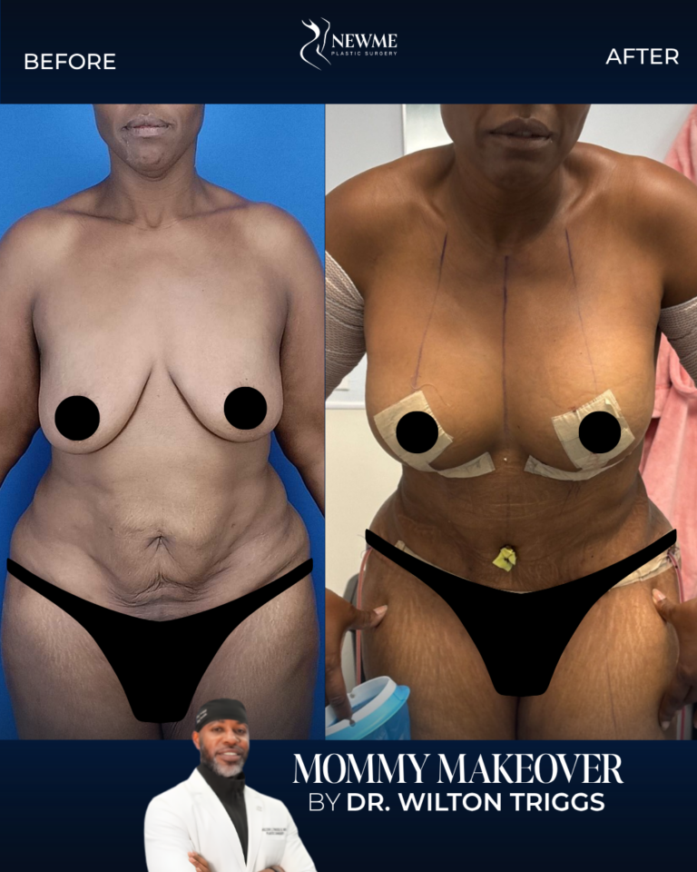 Mommy Makeover result by Dr. Wilton Triggs at New Me Plastic Surgery, Miami