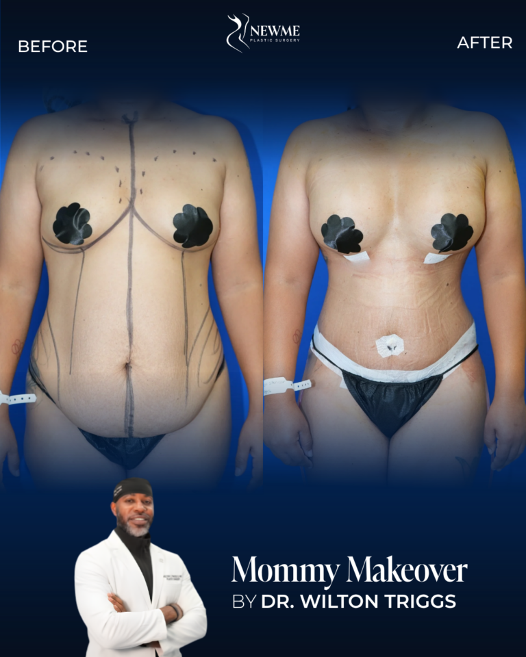 Mommy Makeover result by Dr. Wilton Triggs at New Me Plastic Surgery, Miami