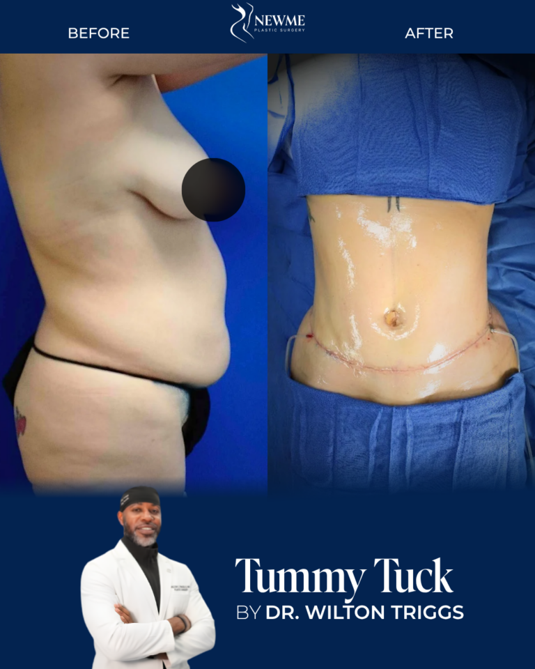 Tummy Tuck result by Dr. Wilton Triggs at New Me Plastic Surgery, Miami